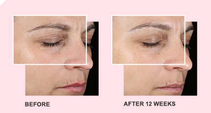 A woman’s face before using TimeWise Miracle Set 3D from Mary Kay. / A woman’s face before using TimeWise Miracle Set 3D from Mary Kay for 12 weeks.