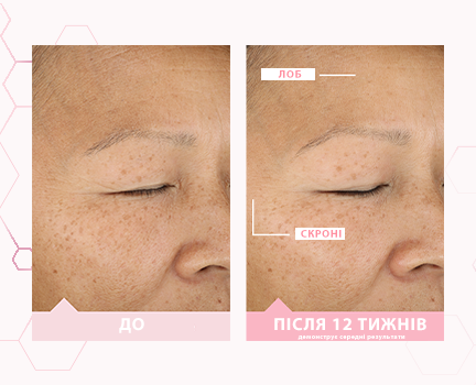 Day 1 and week 12 before and after images showing average skin improvement on the forehead and temple after using TimeWise Miracle Set