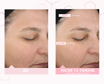 Day 1 and week 12 before and after images showing above average skin improvement on the forehead and cheek after using TimeWise Miracle Set